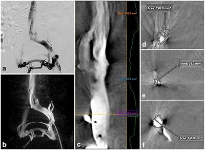 Evaluation of 3-dimensional rotational venography for the diagnosis of non-thrombotic iliac venous lesion